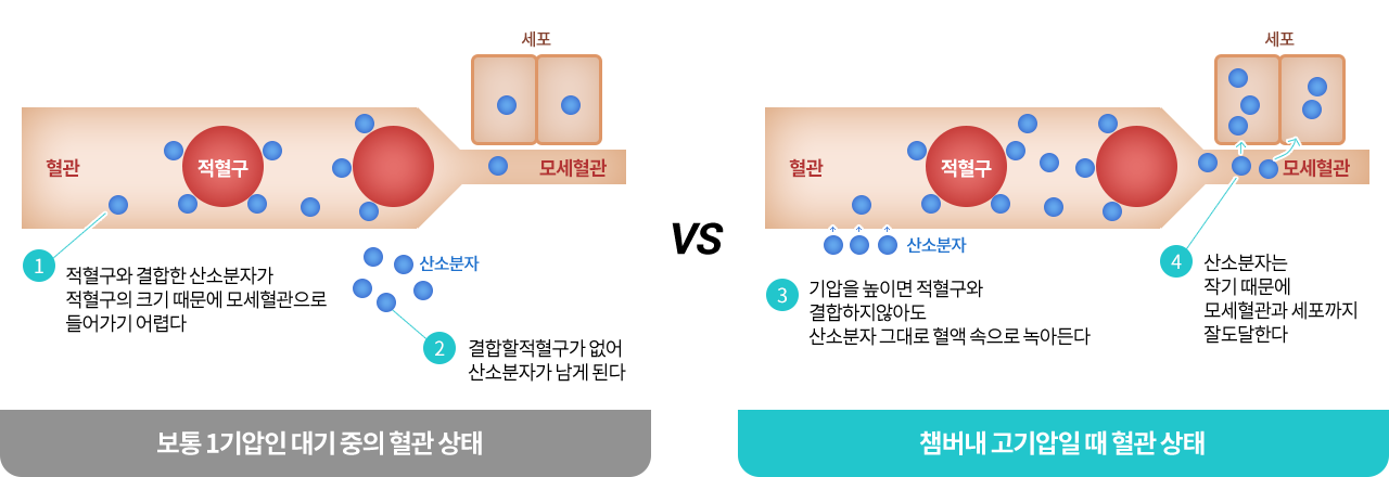 고압산소치료